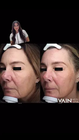 Before & After Sylfirm X #mirconeedling #sylfirmx #medspa #nurseinjector 