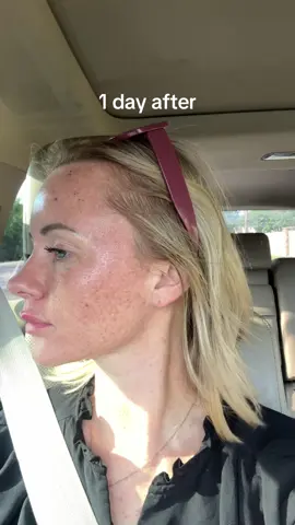Skin healing journey after Bbl/ Moxi laser #bblmoxilaser #laserfacial #skinjourney 