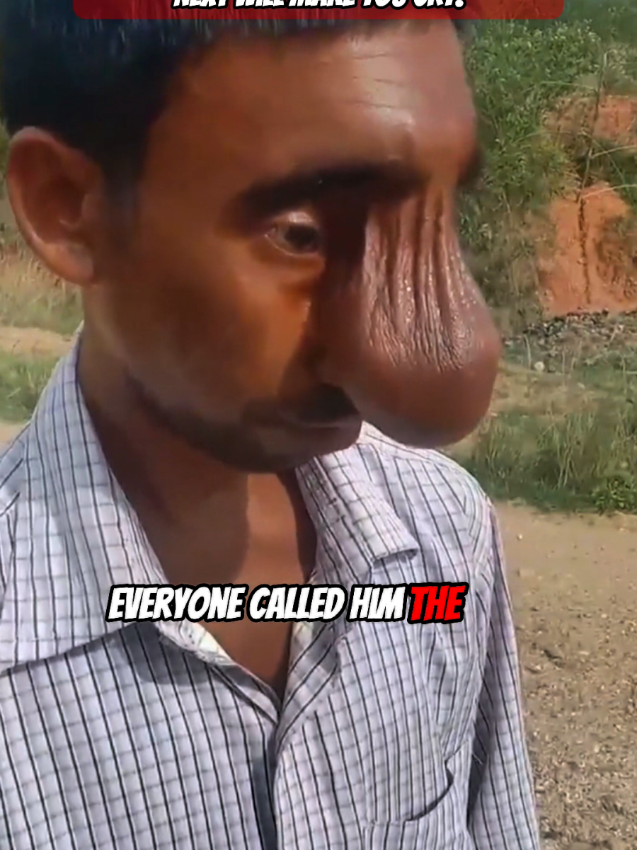 Everyone called him the man with the face of an elephant. But one day a kind hearted american couple invited him for an emergency operation. And what happend next will make you cry. #lifechanging #couplegoals #surgery #help #kindness 