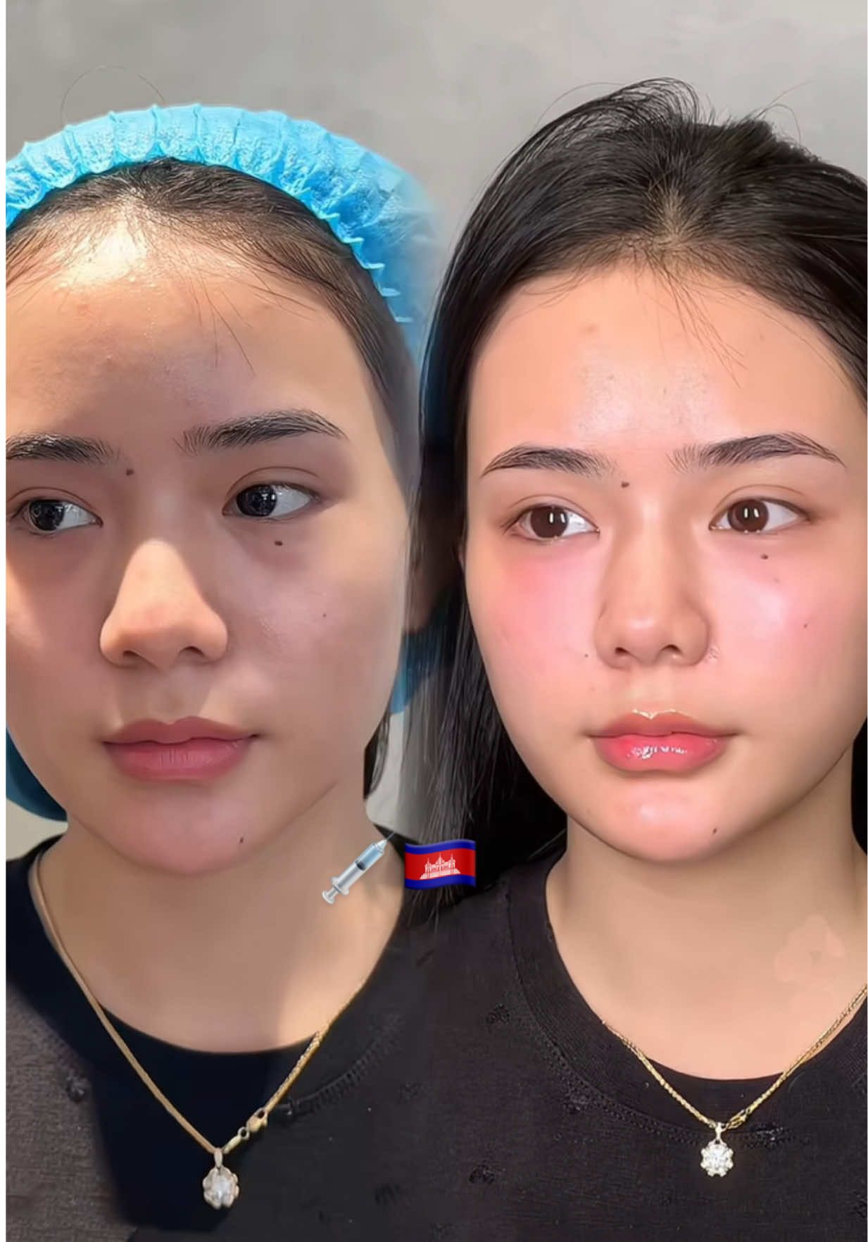 宝贝😘 #cambodia🇰🇭 #fillerpnompenh #fillerbotox🇻🇳🇰🇭