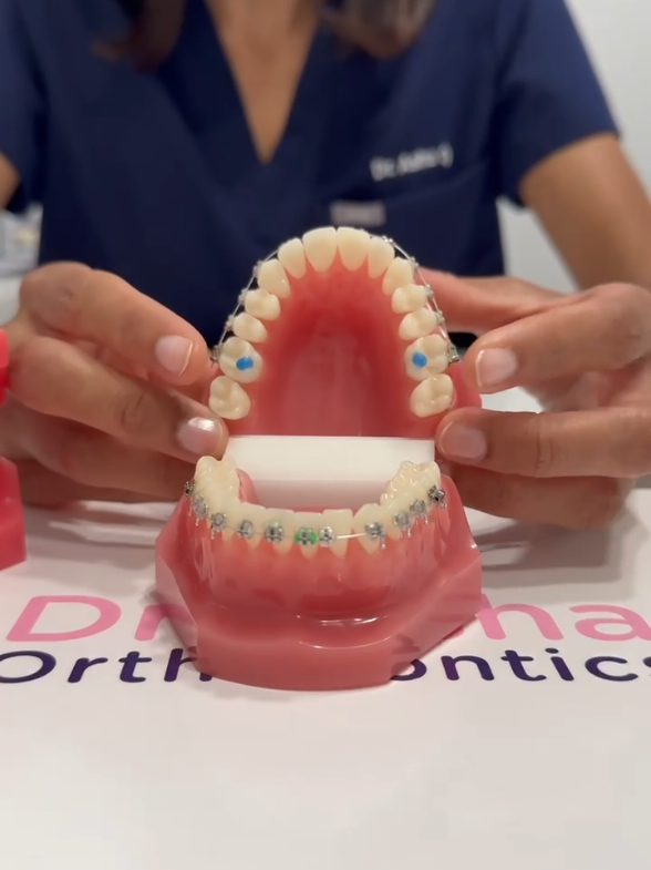 Bite Blocks with Braces When braces are first placed, the top teeth will often bite onto the bottom braces which could cause them to break. In order to prevent this, bite pads are added to create space between the top and bottom teeth when biting down fully. This prevents the top teeth from biting and breaking off the bottom braces.  Common names for Bite Blocks are Bite Turbos, Bite Cushions or Bite Pads. The bite blocks are usually glued onto the back molars and they remain in place for a few months until enough bite correction has been completed and the top teeth no longer bite on the bottom braces. Once there is enough bite clearance and the top teeth are no longer onto the bottom braces, the bite blocks can be removed. #orthodontist #biteblocks #ortho #braces #newsmile     