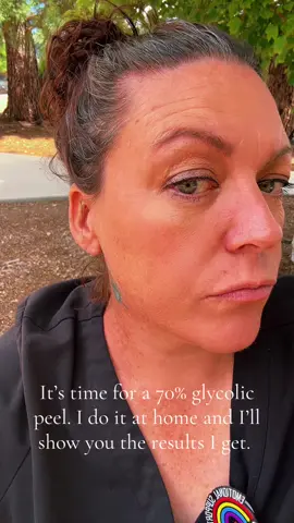 Time for a chemical peel one I use is 70%. I’ll show you the results.