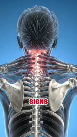 five painful signs you might already have cervical spondylosis—and not even know it #cervical #spondylosis #pain #usa_tiktok #painful 