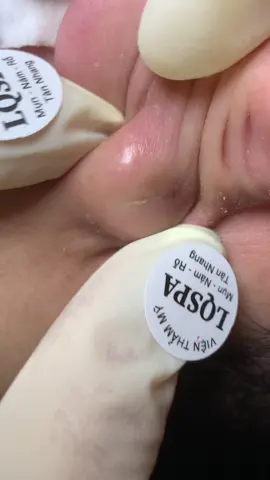 Trắng hú #lqspa#vienthammylqspa#trietlongvinhvien#nanmunbangtambong#chamsocda 