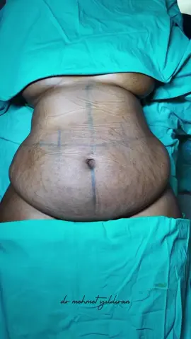 🔥 New body, new confidence! ✨ 360 Liposuction + 270° Tummy Tuck = WOW Results! 💎 Sculpted waist, flat abs & amazing transformation. --- #Lipo360 #TummyTuckTransformation #BodyGoals #PlasticSurgeryTurkey #BeforeAndAfter