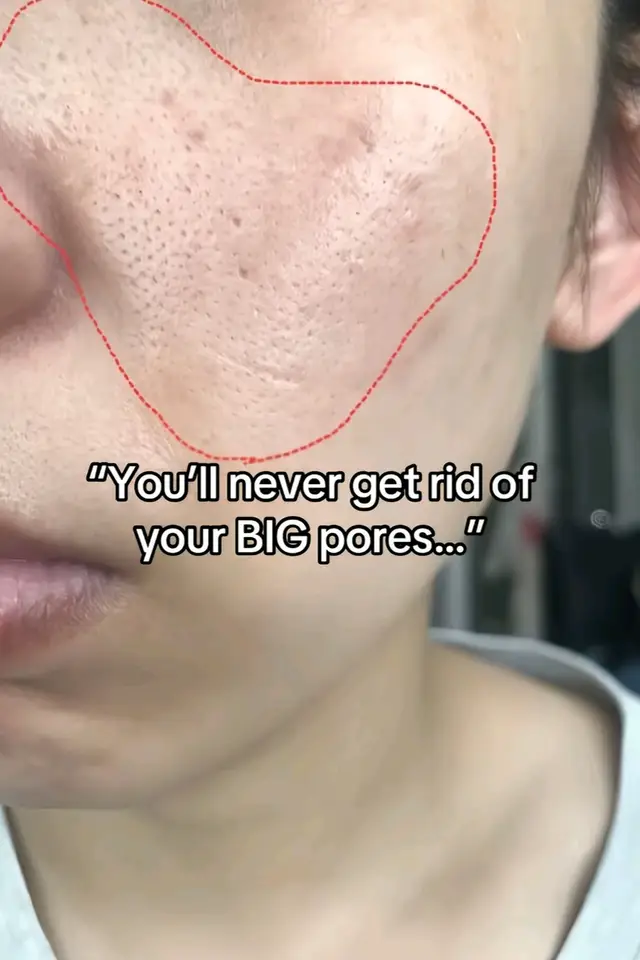 Just trust the process 🙏  #skincarenepal #zuwacosmeticsproducts #tiktoknepal #poresserum #zuwacosmetics 