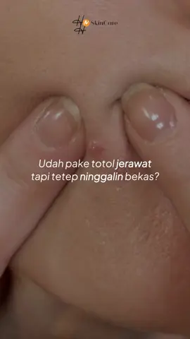 Solusi untuk jerawat aktif, bonus samarkan bekas jerawat juga🥰💚 #hnhskincarebydrkamilajaidi #dikawalsampaiglowup #24hours