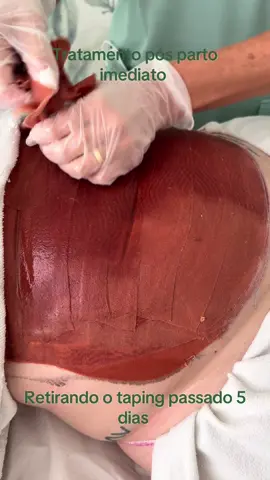 Tratamento pós parto imediato. Retirando o taping. #tapingnoposparto #taping #tratamentoposparto #gratidao #portugal🇵🇹 