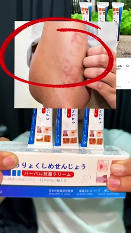 Kem bôi trị nấm ngứa ghẻ lở dị ứng thời tiết hoặc do côn trùng đốt #kemboinamngua #kemboinamnguanhatban #langbenhaclao #giadungtienich #hảogiadung68686 