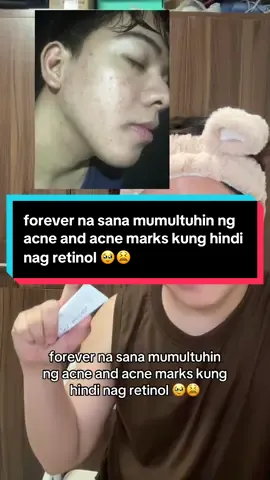 forever na sana mumultuhin ng acne and acne marks kung hindi nag retinol 🥹😫 #fyp #retinol 