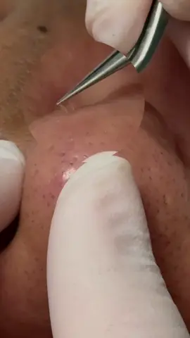 Kỹ thuật độc quyền tại Moana là đây! Top1 nằm trong mọi liệu trình chăm da: Acne Tweezer #moanabeauty #asmr #acnefighter #acnetreatment 