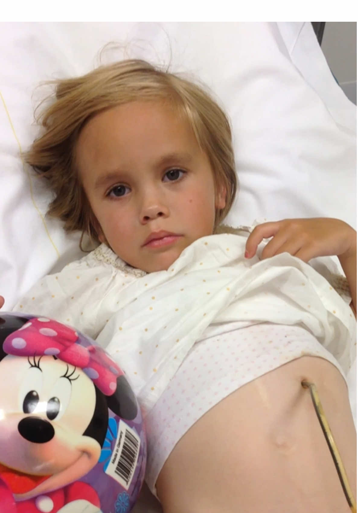 MY TRAUMA  🇳🇱: Aug. 29, 2014 I had suffered my trauma. At my elementary school, you had two playgrounds. From grade three you were allowed to go to the big playground. Of course, that was super cool and very cool. You also had a climbing frame there. The first few days of grade three went really well. But on Friday, the end of the first week at school, it went wrong. I wanted to climb and a friend wanted to lift me up (I was too small haha) and fell on my snakes.  It happened so fast that I actually didn't feel any pain. But even at that young age I had a moment to check if the peg tube was still okay. I pulled up my sweater and before I knew it I was screaming in fear. My peg tube was hanging out of my belly (I know that my tube changes back then were done under anesthesia, so I had never seen my peg tube hanging out of my belly before).  The headmistress switched gears right away and called mom. While Mom was running to school, the principal had already called 911. The ambulance was on its way and before I knew it I was on my way to the hospital. At the hospital, they tried to push the tube back in (often), but my hole in my belly had grown closed so quickly that the tube could no longer go in.  There was no other option but a nasogastric tube. They had placed a catheter so the hole could slowly grow back open. The nasal probe had been placed after a whole lot of misery (I hate nasal probes and especially the placement). After a long day in the hospital, I was allowed to go home. Mom surprised me because in the evening The Voice Kids came on!!! So we went to watch that. I watched the first minute and then I fell asleep.  I had to walk around with the nasal tube for six weeks. You can imagine that if this had happened before the summer vacation I would have had to walk around with a nasal tube for the whole summer vacation. Of course that doesn't make it any less bad but then you can imagine a little bit how long that actually is. After many therapy sessions, I can tell this story again. But that took a long time. ❤️ #fy #foryou #fyp #foryoupagе #viral 
