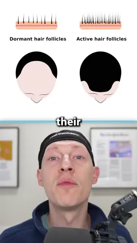 New hair loss cure? PP405 #pp405 #hairlosscure #hairloss #recedinghair #hairtransplant 