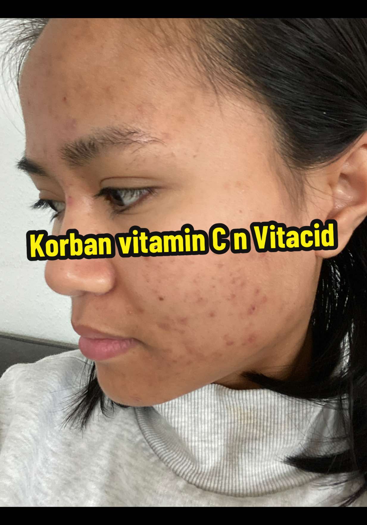 Lagi syukaaa banget sama muka 😁😁😁 Korban vitamin C + Vitacid 🤭🤭🤭 #Skincare  #vitacid #beauty #Girl #vitaminc 