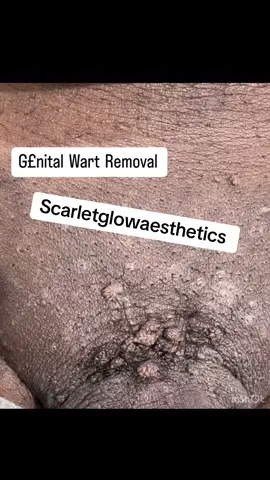 Genital warts are soft growths that appear on the genitals. They can cause pain, discomfort, and itching. Genital warts can be so small and flat as to be invisible. Rarely, however, genital warts can multiply into large clusters in someone with a suppressed immune system. Book your appointment now!!! 📲07039242962 #scarletglowbeautyspa #anambraspa #owerrispa #asabaspa #enuguspa #awkaspa#wartremoval 