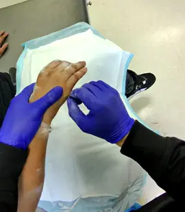 Taking a pin out of a 5th metacarpal fracture  #ortho life  #surgicaltechnologist  #fractures 