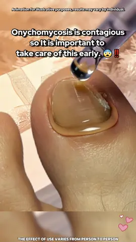 If your nails also encounter this situation, please try this method.#nailcare #fyp #tiktokshop #tiktokmadebuyit #fallfreshness 