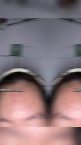 Bye mụn sưng viêm 👋🏻 #reviewlamdep #xh #trimun #caryophy #duongda 