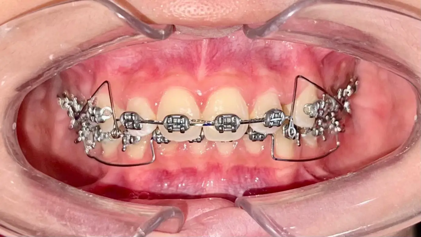 Trường hợp nhổ R4 dạng sinh học bệnh nhân Brachy.  XHD xoay đóng. Thật vất vả 😭😭😭.  Mãi cũng gần đến đích, đóng khoảng xong tiếp tục Geaw tăng VD để Finish ổn định.  Kinh nghiệm là hạn chế nhổ R dạng bệnh nhân Brachy.