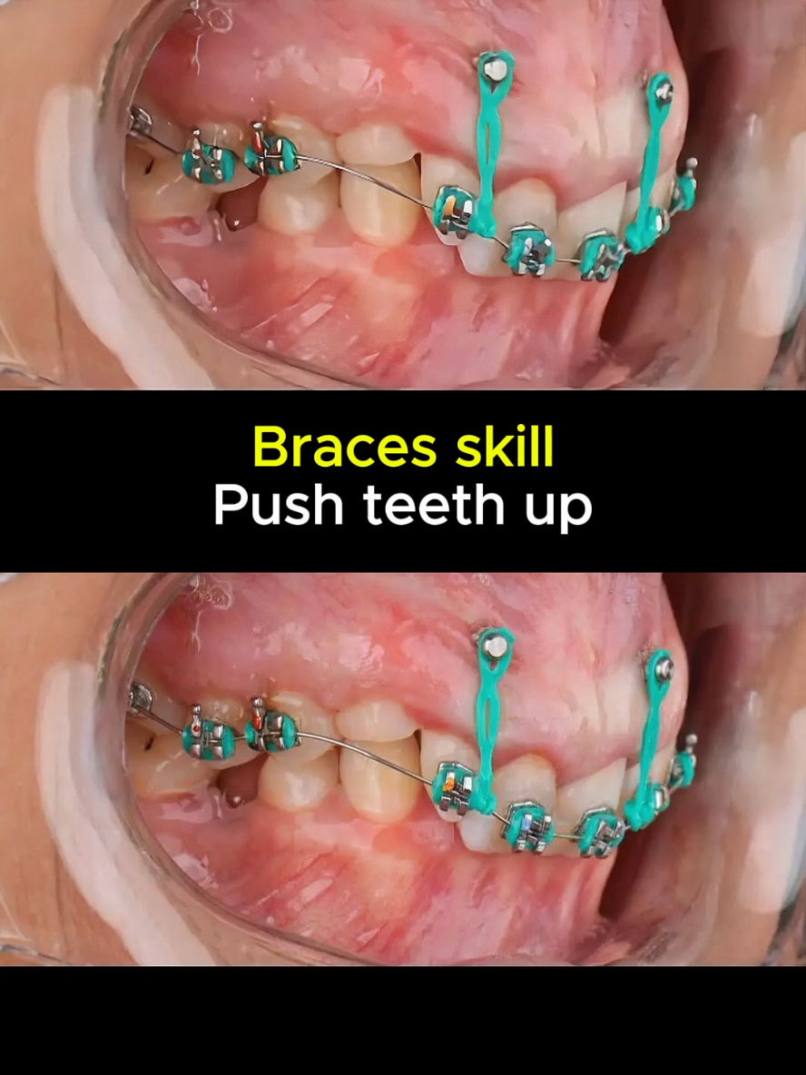 Fix deepbite and gummy smile with braces. #dentist #braces #orthodontist 