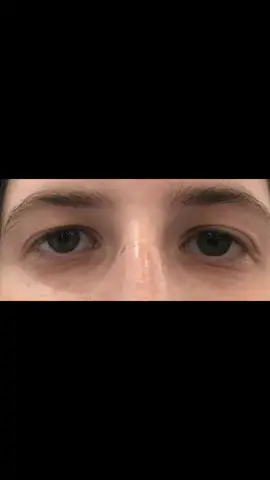 Eye pill #fyp  #edit