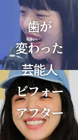 歯が変わった芸能人ビフォーアフター　#ガルちゃん #芸能人 #歯並び 
