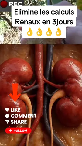 elimine les calculs rénaux en 2jours#santé #foru #foryoupage❤️❤️ #tiktokviral #france🇫🇷 @tiktok creators 