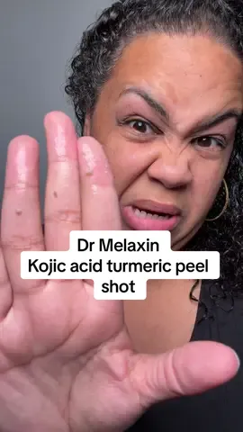 It’s literally magic! It runs the dark marks right out! I also use for my underarms and inner thighs! #drmelaxin #drmelaxinpeelshot #kojicacid #hyperpigmentation #tumeric 