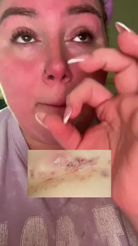 Replying to @Brandy Sadie and Jack Jack ❌ Hidradenitis suppurativa is such a debilitating condition #hswarrior #hidradenitissuppurativa #hidradenitissuppurativawarrior 