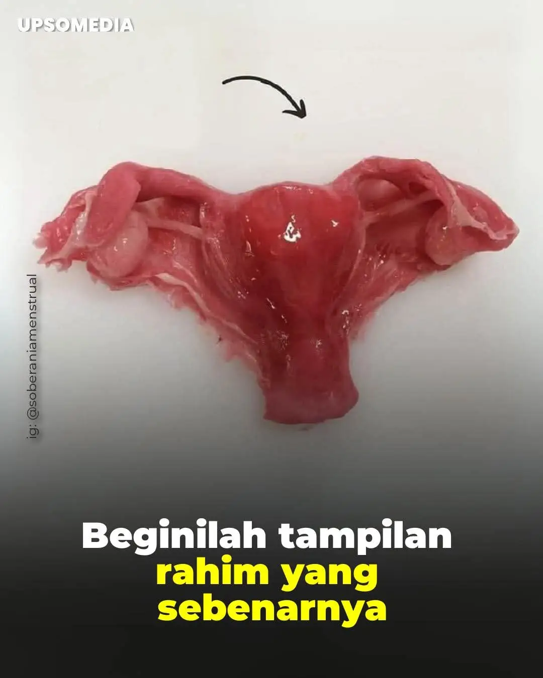 Bukan gambar atau animasi 3D: ini adalah foto dari rahim yang nyata, di mana kita bisa melihat dengan jelas leher rahim, tubuh rahim, tuba falopi, ovarium, dan ligamen. Organ ini, yang rata-rata berukuran sekitar 7 hingga 8 sentimeter, mampu mengembang hingga lebih dari 500 kali ukurannya selama kehamilan, menampung dan melindungi janin hingga kelahiran.