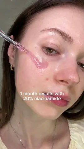 Korean Dark Spot Remover for sensitive skin ✨ @Jumiso Official Niacinamide 20 Dark Spot Remover Serum is now available on Amazon 💜 #JUMISO #Niacinamide #DarkSpotRemover #hyperpigmentation #SkinTransformation