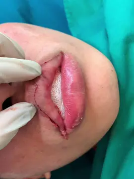 Cắt môi nam tại Bắc Ninh #xuhuongtiktok #bacninh #cắtmôidày #cattaohinhmoi #cắtmoi 