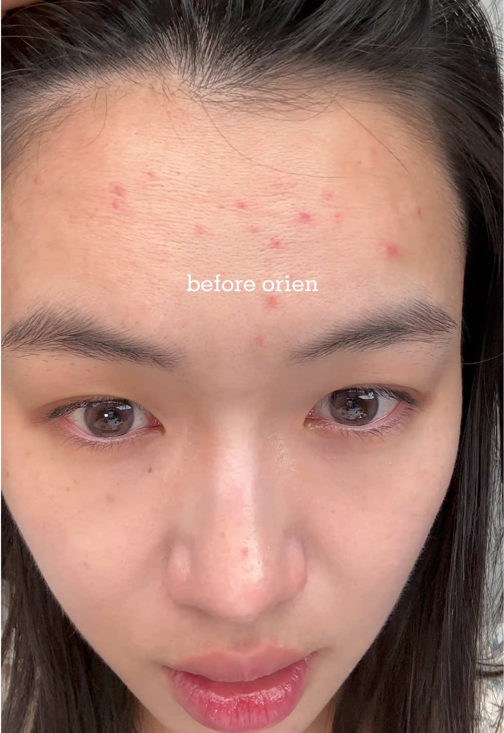 Always with you #orien #zerofilmchallange #moisturizerviral #mugwortmoisturizer #acnescars 