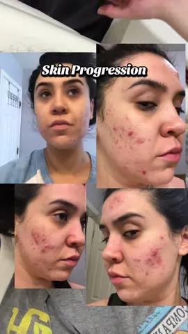 And this is what we call PROGRESS 🥲🥲 #medspa #acneproneskin #acnejourney 