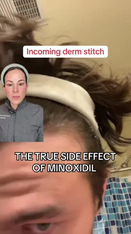 Minoxidil is no doubt the most effective topical over the counter hair growth product on the market but there’s some hacks you need the to know to get the most of our it! Stitch with @CadeHairFix  as always consult your doc before you use Rogaine but it’s generally a well tolerated treatment worth exploring for hair regrowth Let me know below if you have questions about minoxidil for hair growth!