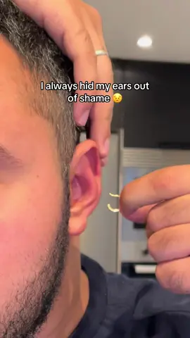 This earring-shaped corrector is perfect for avoiding ear surgery (otoplasty) and sticking-out ears