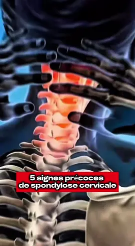 5 signes précoces de spondylose cervicale. #sante #santenaturelle #france 