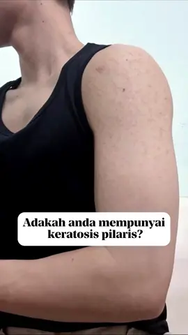 Bagaimana Saya Menghilangkan Keratosis Pilaris🤔 #follicas #follicasmalaysia #keratosispilaris #strawberryskin #tiktokmalaysia 