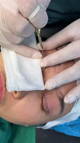 Ở đây có mí xinh #cắtminideep #sửamí #thammytunhien #thammyngoccuong 