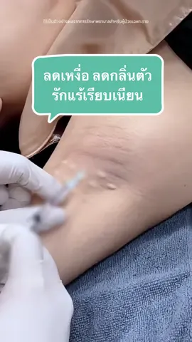ลดเหงือ ลดกลิ่นตัว รักแร้ไม่เรียบเนียน💉 #ลดเหงื่อ #ลดกลิ่นตัว #รีวิวสกินแคร์ #ครีมทารักแร้ #รักแร้ขาว  @Pattippa Clinic หมอเต้หมอเธีย  @Pattippa Clinic หมอเต้หมอเธีย  @Pattippa Clinic หมอเต้หมอเธีย 