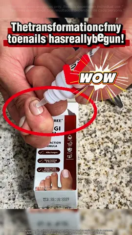 Only those who use it know how good it is! My feet are the best proof!#nailcare #toenails #naturalrmedies #tiktokmademebuyit #foryourpage 