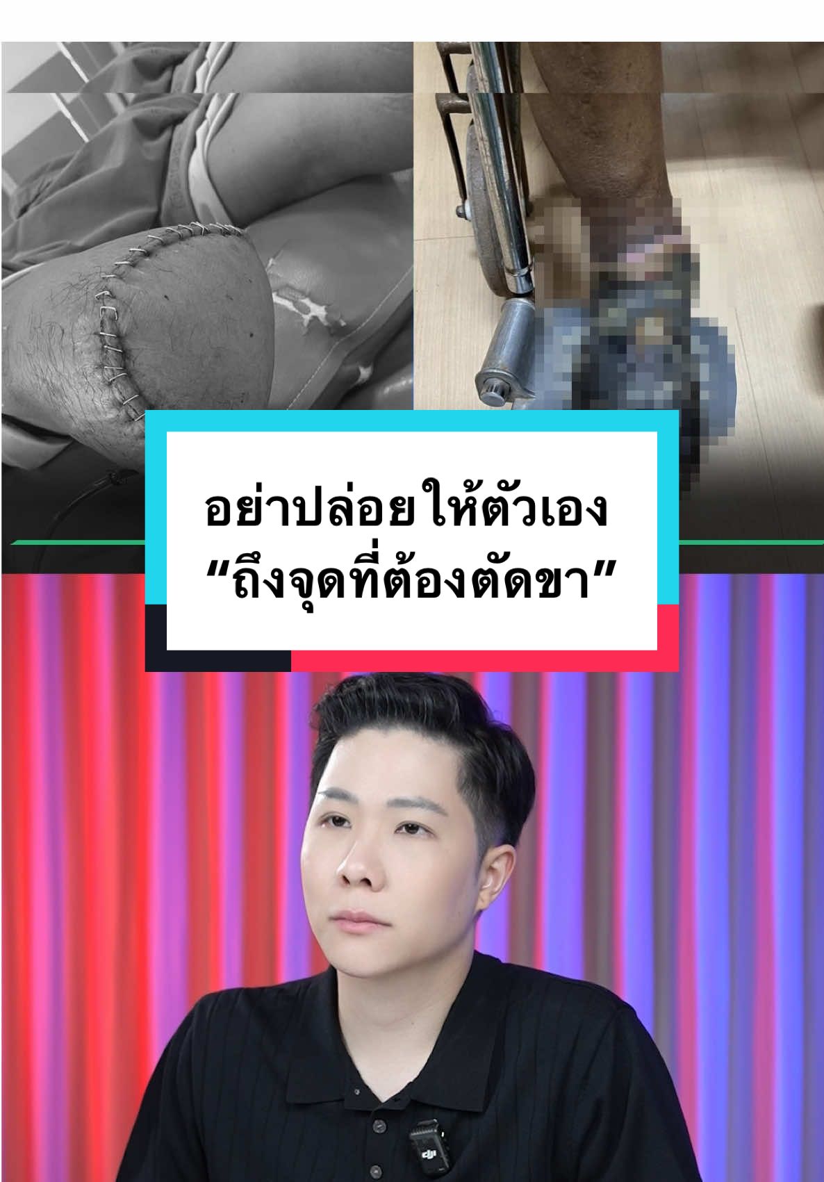 รีบไปโรงพยาบาล…อย่ารักษาเองแบบผิด ๆติดเชื้อ ตะปูตำ งูกัด เเผลเบาหวาน #winwejpisit 