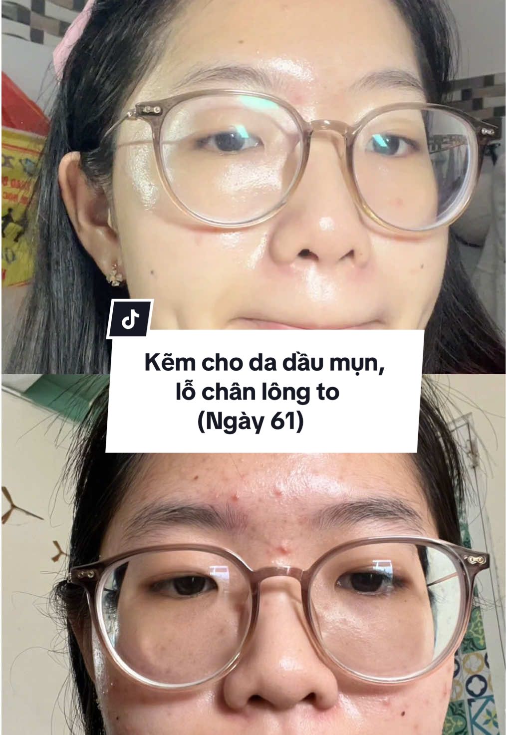 Ngày 61/100 ngày. Một tuần rồi ko gặp mọi người 👉👈 Mình đã hong định chia sẻ về chăm da mụn nữa rùi nhưng thấy mọi người nhắn hỏi mình về cách dùng của serum kẽm này nhiều lắm nên hôm nay mình chia sẻ cách dùng và kết hợp trong routine sao cho hiệu quả nhanh nhất nhaa 🥺🥰  Nếu muốn thử dùng thì nhất định phải xem qua đó nhaa    #ekseption #mituueh #skincare 