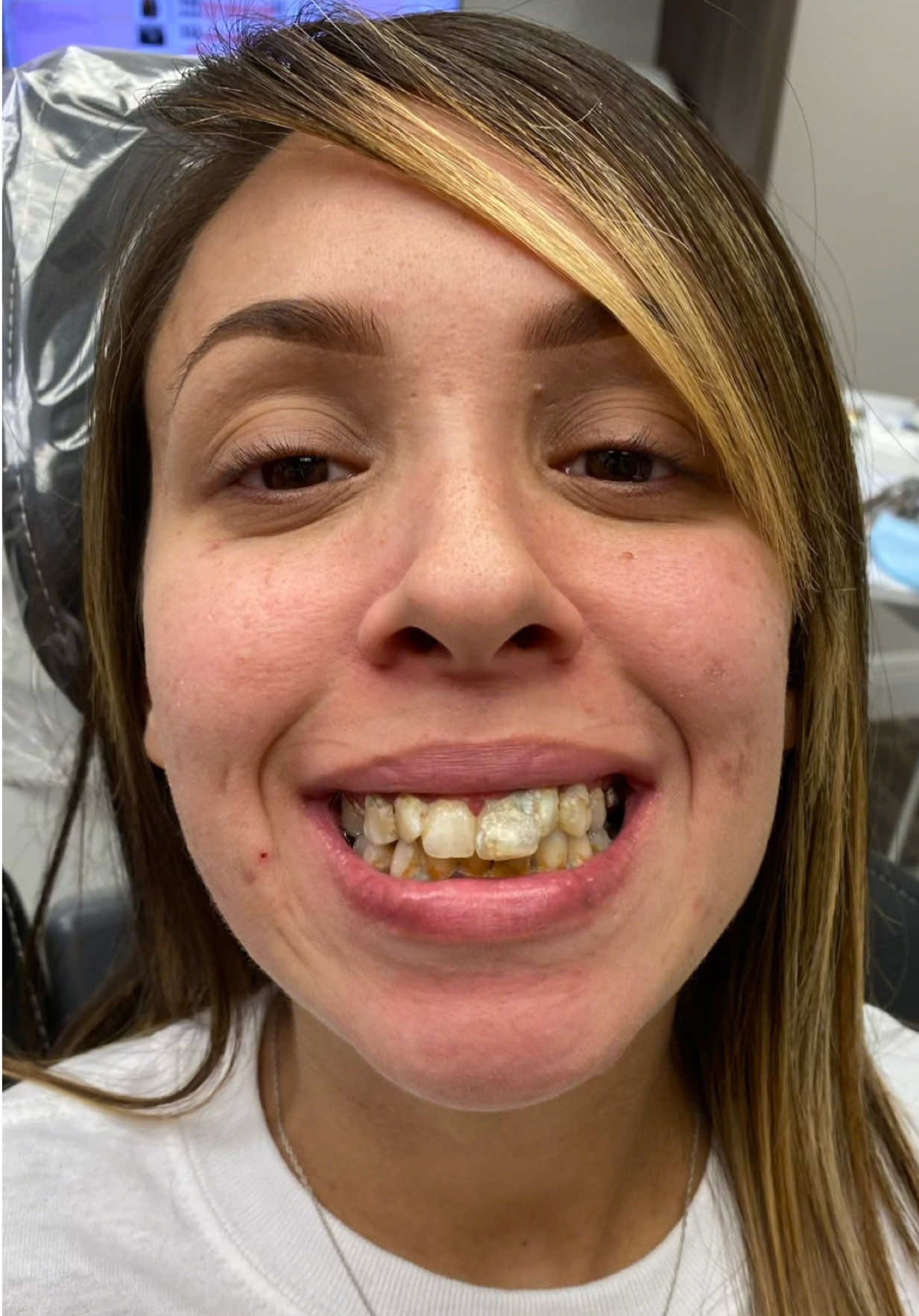 Most would have told her to pull them all… She thought she lost her chance. But now her smile is stronger than it’s ever been. #dental #makeover #shocking #shorts #fyp  