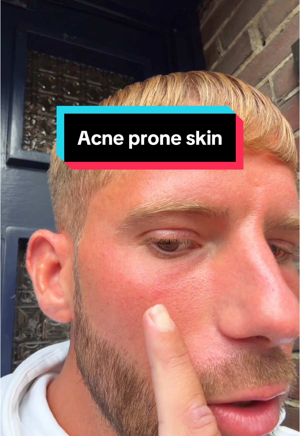 Acne prone skin of littekens?  #acne #glowingskin #acneproneskin #fitgirls #fitmen #acneskincare #skincaretips #scarhealing 