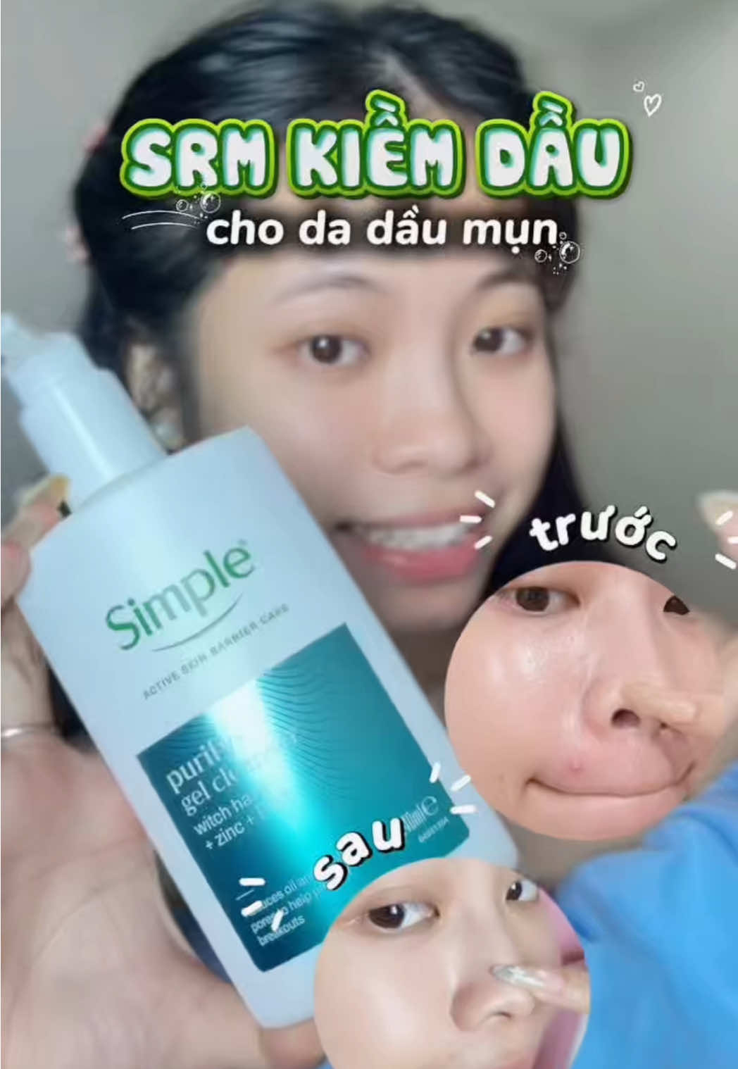 Sữa rửa mặt cho da dầu mụn chai to dùng lâu cho các bà #dongianlaSimple #damunchonSimple #SkinTwin #hoptaccungUnilever