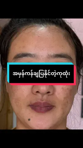 တင်းတိတ်စုံနေပီးကုတာမသက်သာလို့မပျောက်လို့ MaiMaiBeauty မှာစက်မပါအပ်မပါလေဆာအထူးကု(၁)လရလဒ်#တင်းတိတ်အထူးကု #MaiMaiBeautyAcademy #maimaiတင်းတိတ်အထူးကု #တောင်ကြီး #စက်မပါအပ်မပါလေဆာမပစ်တင်းတိတ်ကုထုံး 