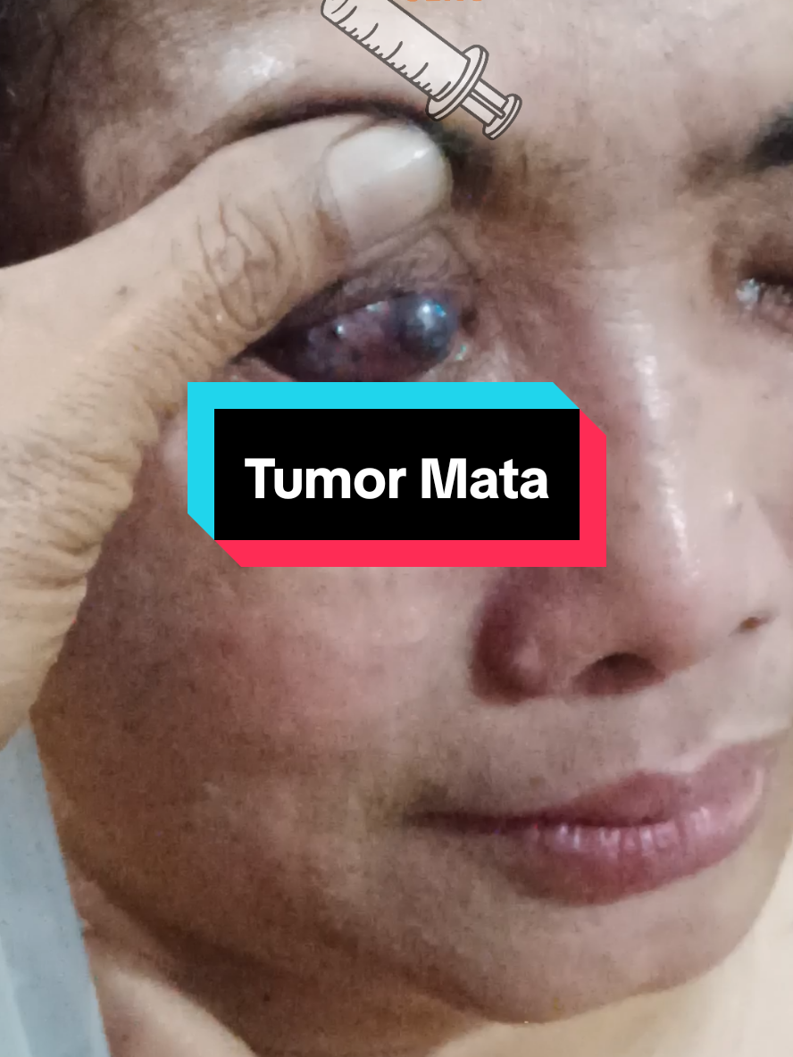 “Dua benjolan di mata karena tumor… Setelah 1 bulan terapi asap kretek rempah Karang Daleman, makin membaik 🙏 #tumor #tumorcerebral #kanker #retinoblastoma #ocular
