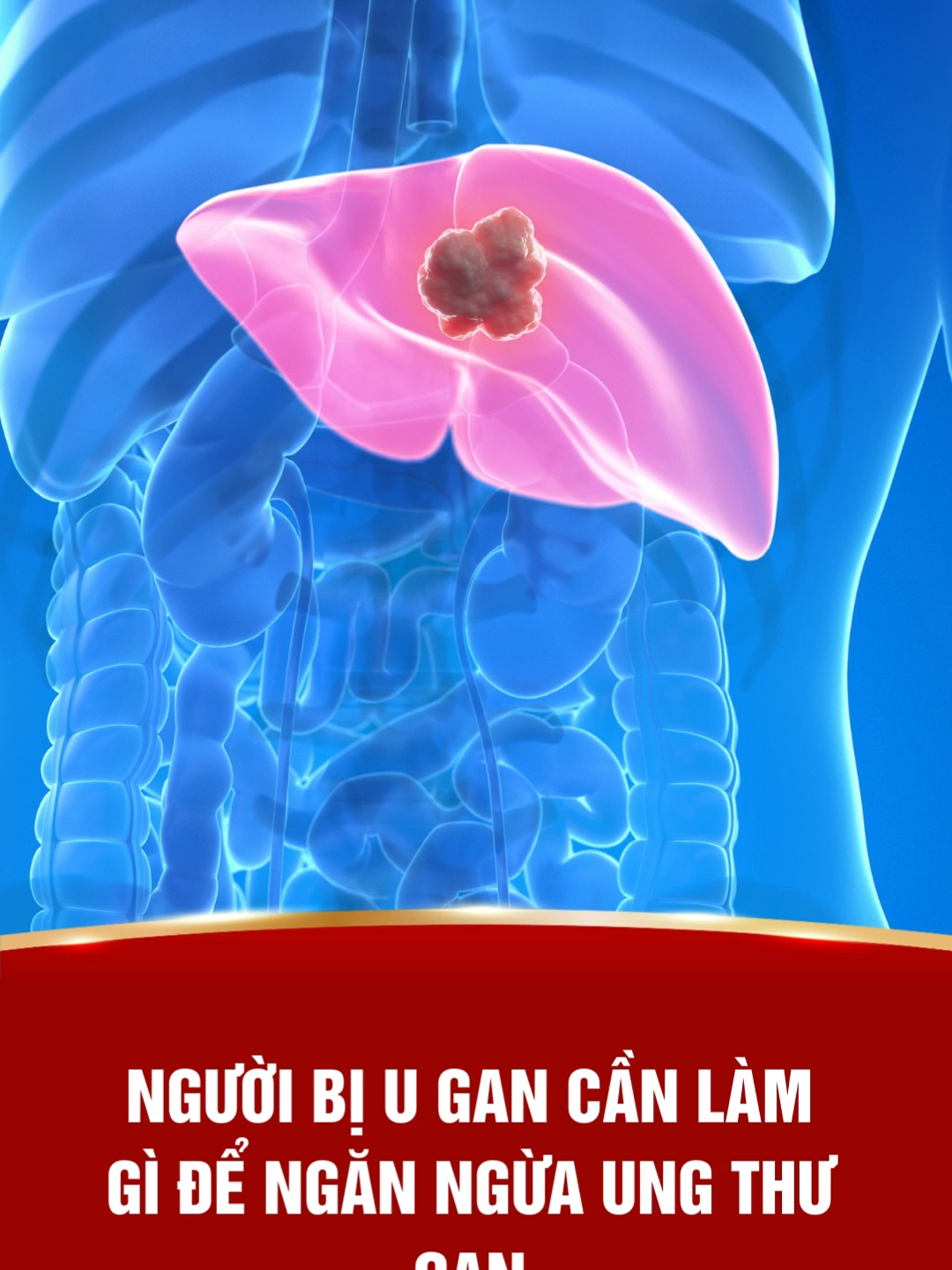 Người bị u gan cần làm gì để ngăn ngừa ung thư?  #ungthu #oncolysin #songkhoe #ugan #k #ungthugan