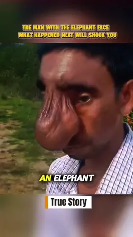 The Man With the Elephant Face A U.S. Couple Changed His Life Forever  #TrueStory #AmericanStories #USInspiration #RealPeopleUSA  #USATrending